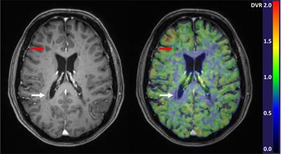 Evaluation of Microglial Activation in Multiple Sclerosis Patients Using Positron Emission Tomography